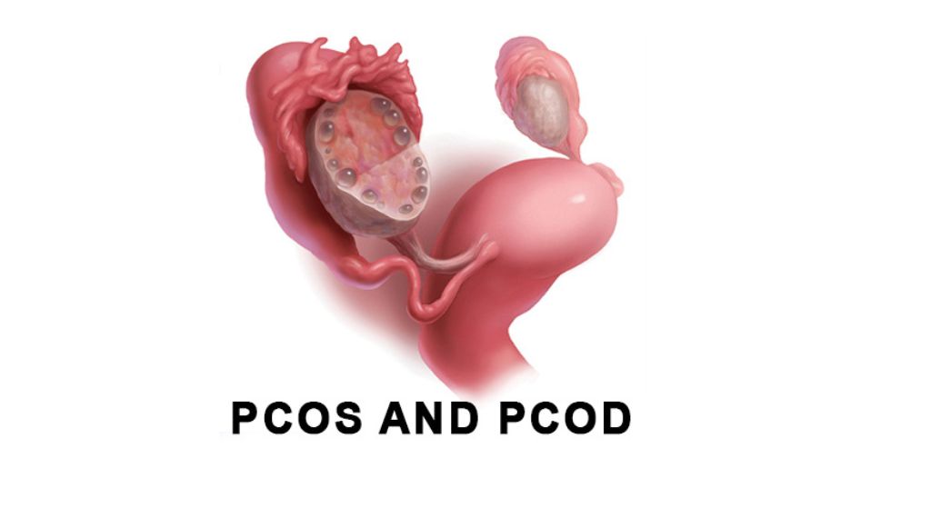 Searching for the Best Irregular Periods Care in Faridabad? | PCOS & PCOD Treatment