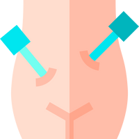 Laparoscopy